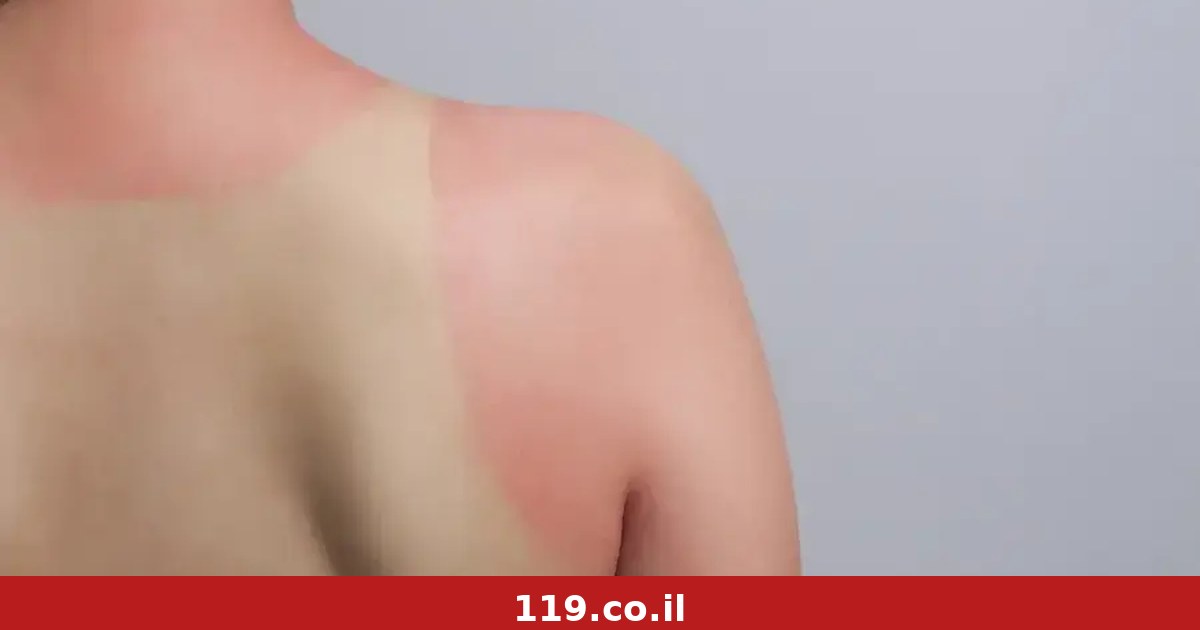 כוויית שמש קשה אחת מותירה נזק לשנים: הממצא המדאיג שהתגלה במחקר